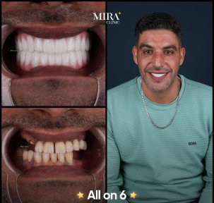 before-after photo all-on-4-dental-implants