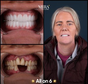 before-after photo all-on-4-dental-implants