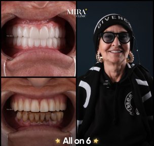 before-after photo all-on-4-dental-implants