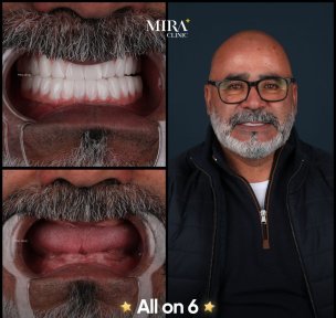 before-after photo all-on-4-dental-implants