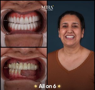 before-after photo all-on-4-dental-implants