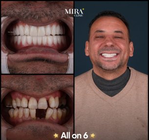 before-after photo all-on-4-dental-implants