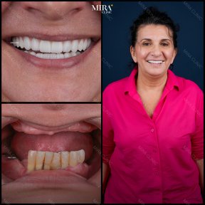 Smile makeover before and after results at Mira Clinic, dental veneers for brighter teeth
