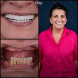 Smile makeover before and after results at Mira Clinic, dental veneers for brighter teeth
