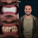 Smile makeover before and after results at Mira Clinic, dental veneers for improved teeth alignment