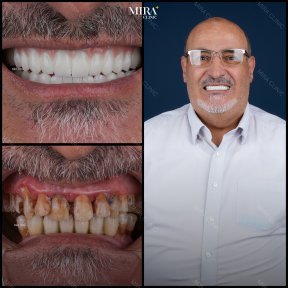Smile makeover before and after results at Mira Clinic, dental restoration with veneers and crowns