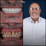 Smile makeover before and after results at Mira Clinic, dental restoration with veneers and crowns