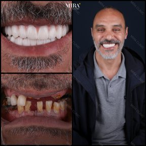 Smile makeover before and after results at Mira Clinic, full dental restoration transformation