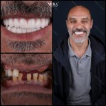 Smile makeover before and after results at Mira Clinic, full dental restoration transformation