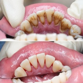 before-after photo glubokaya-chistka-udalenie-zubnogo-kamnya-i-sglazhivanie-korney
