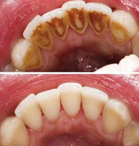 before-after photo glubokaya-chistka-udalenie-zubnogo-kamnya-i-sglazhivanie-korney