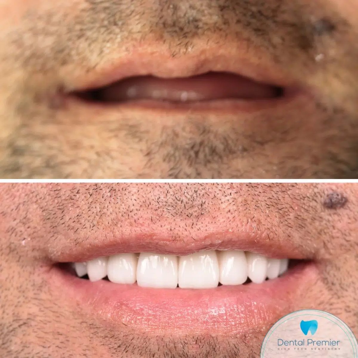 نتيجة قبل وبعد زراعة الأسنان All-on-4 في Dental Premier، ابتسامة مستعادة