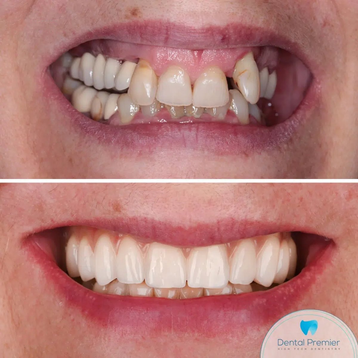 Antes y después de implantes dentales All-on-4 en Dental Premier, resultado de sonrisa completa