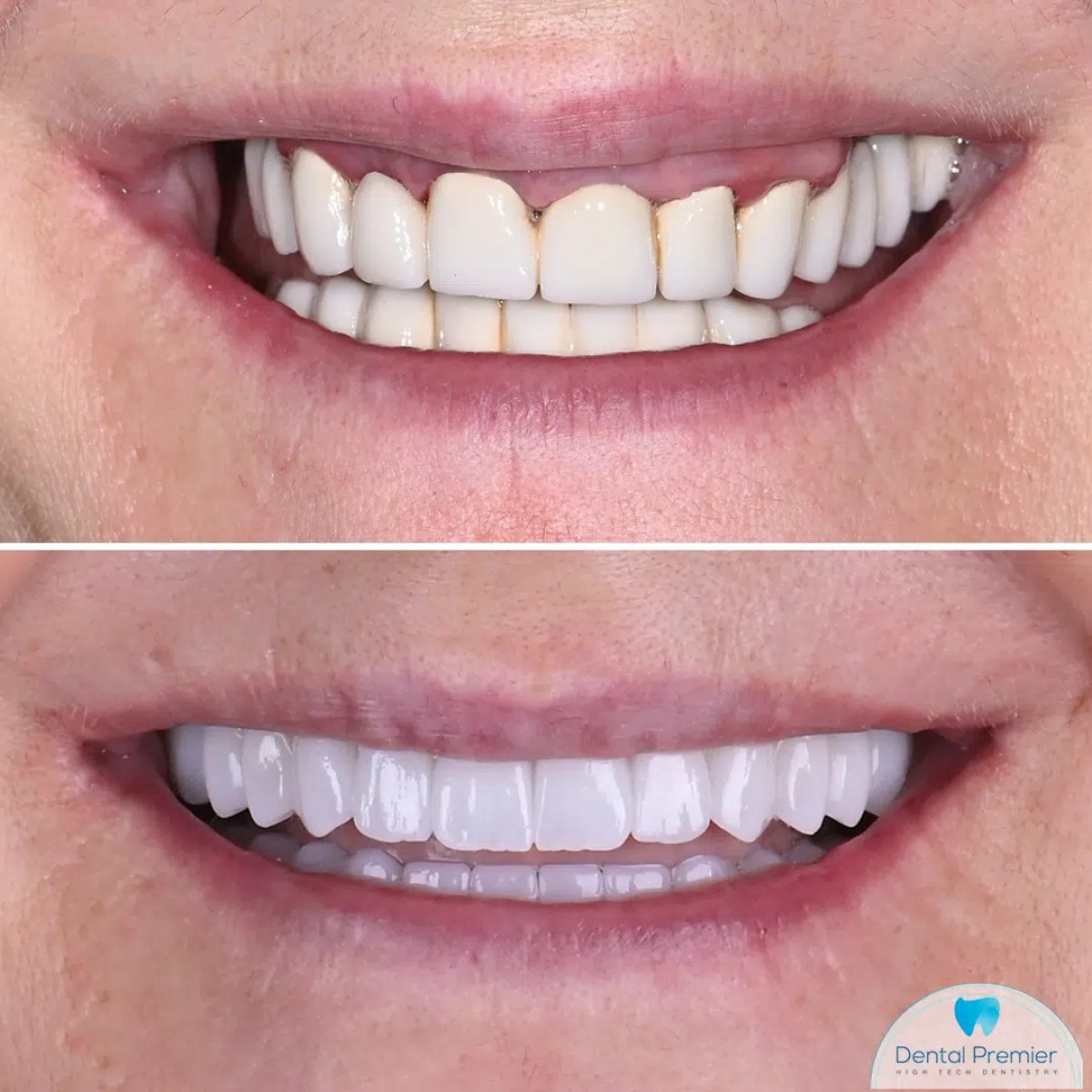 نتائج قبل وبعد زراعة الأسنان في Dental Premier، ابتسامة محسنة ومظهر طبيعي للأسنان