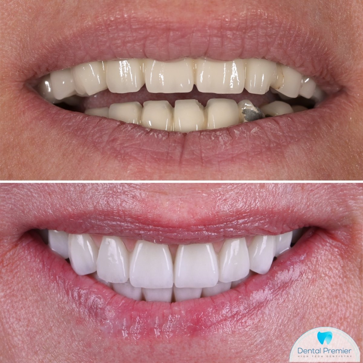 Resultados de implantes dentales antes y después en Dental Premier, sonrisa mejorada y dientes blancos