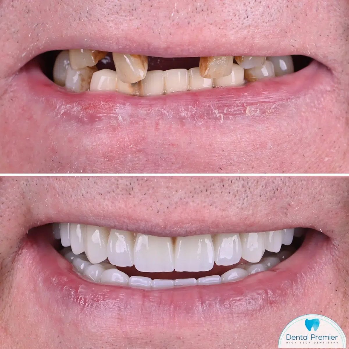 Resultados antes y después de prótesis fija de zirconia sobre implantes en Dental Premier
