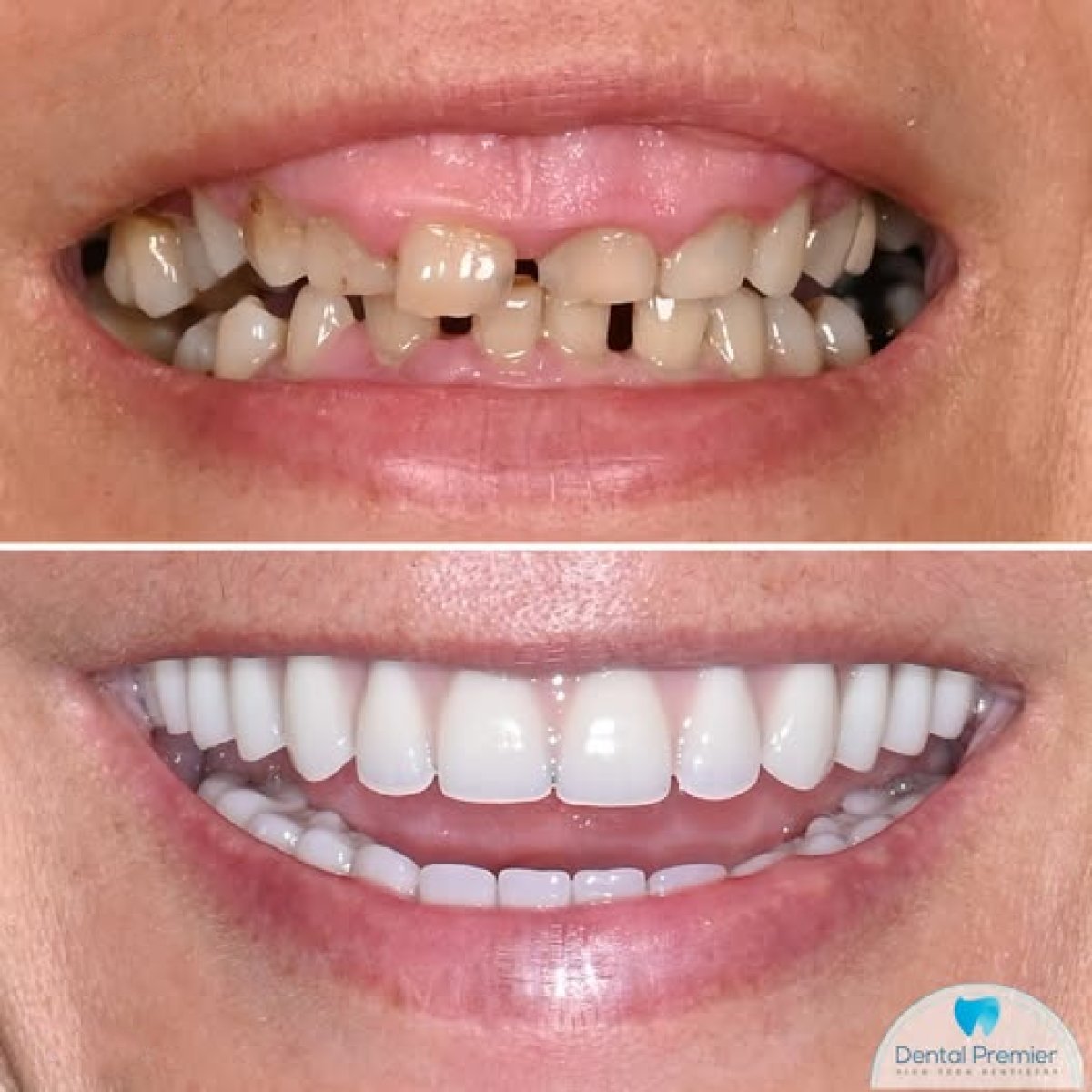 Resultados antes y después de carillas de porcelana en Dental Premier – sonrisa transformada