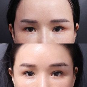 before-after photo blepharoplasty-eyelid