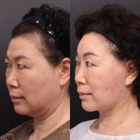 before-after photo tightening-of-facial-skin-facelift