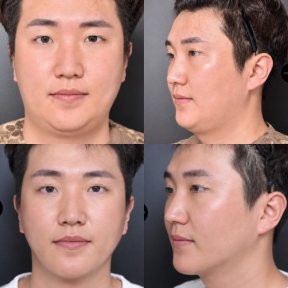 before-after photo jawline-contouring
