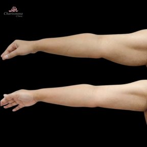 before-after photo liposuction
