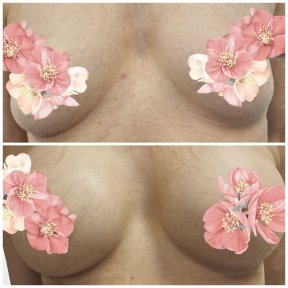 before-after photo breast-augmentation