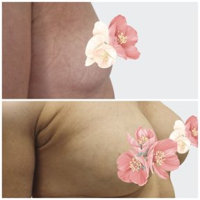 before-after photo breast-augmentation
