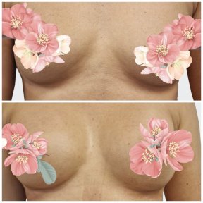 before-after photo breast-augmentation