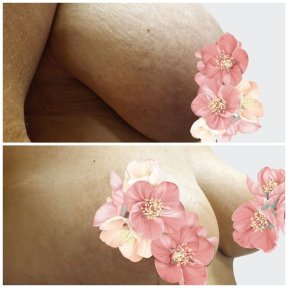 before-after photo breast-reduction