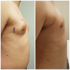 before-after photo gynecomastia-surgery