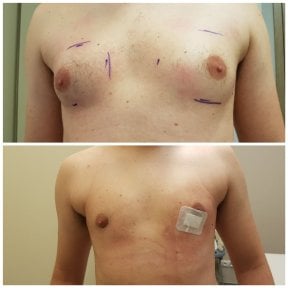 before-after photo gynecomastia-surgery