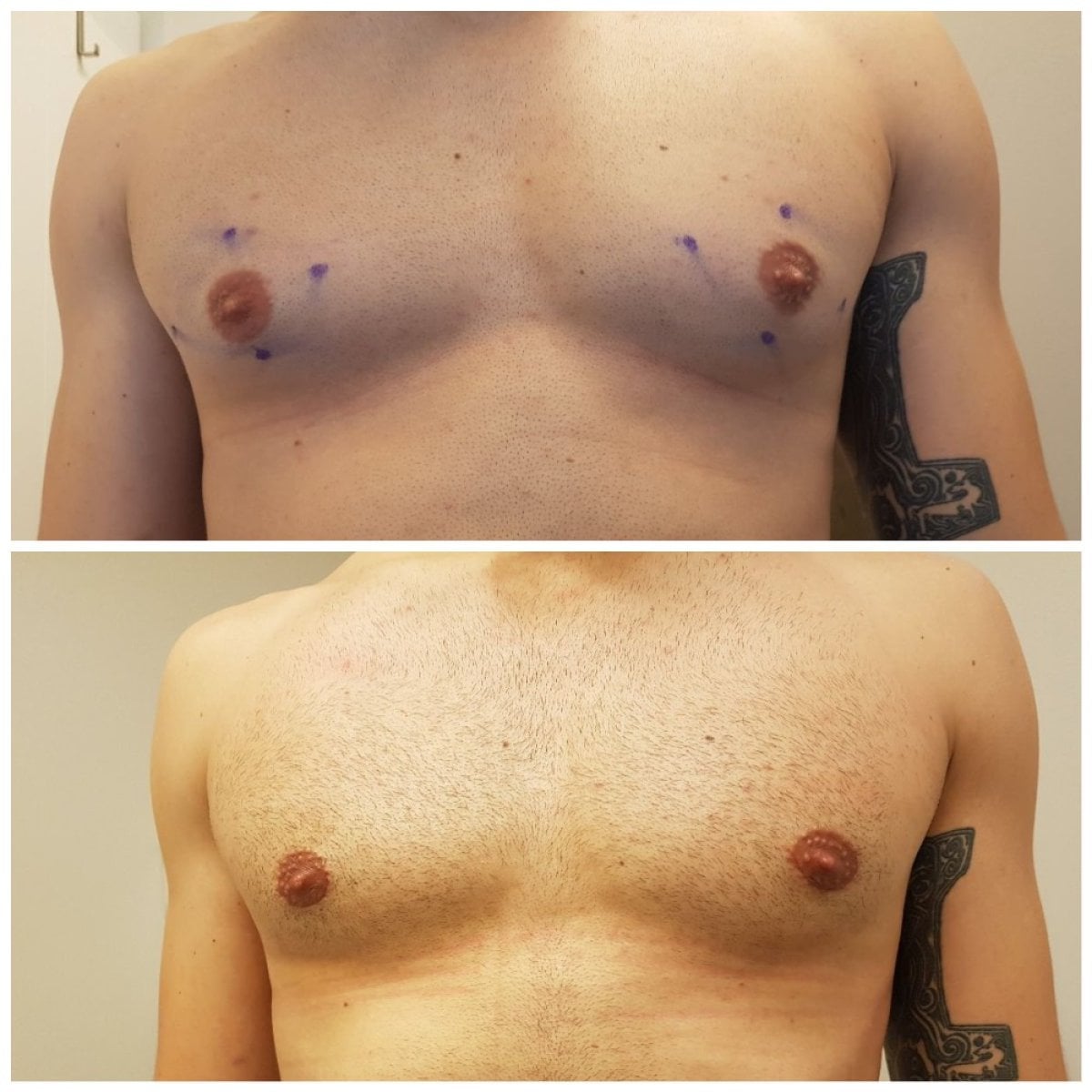 Resultados antes y después de cirugía de ginecomastia – pecho masculino más plano