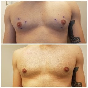 before-after photo gynecomastia-surgery