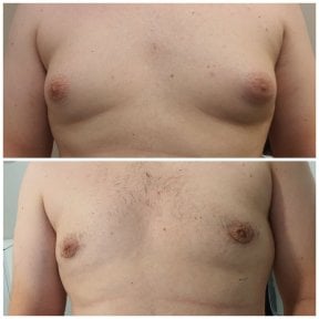 Before and after gynecomastia surgery results – male chest contour improvement