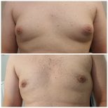 Before and after gynecomastia surgery results – male chest contour improvement