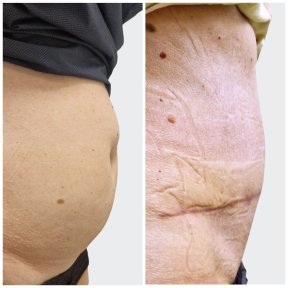 before-after photo abdominoplasty