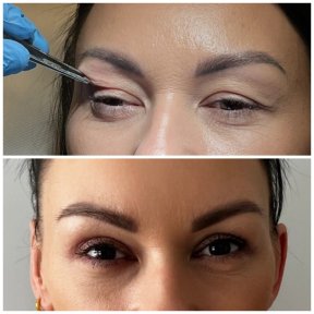 before-after photo blepharoplasty-eyelid