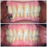 Before and after dental implant results – improved tooth alignment and smile aesthetics