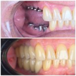 Before and after dental implant results – restored lower teeth and improved smile