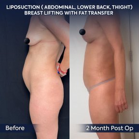 before-after photo liposuction
