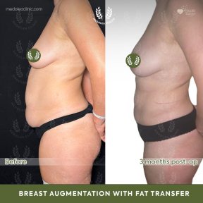 before-after photo liposuction
