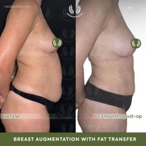 before-after photo liposuction