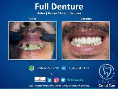 before-after photo denture