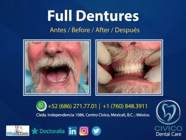 before-after photo denture