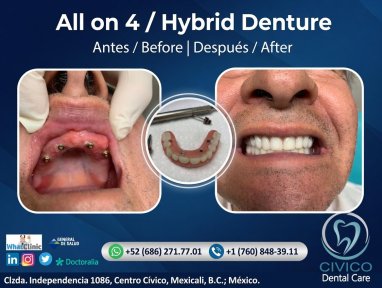 before-after photo denture