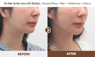 before-after photo mini-facelift