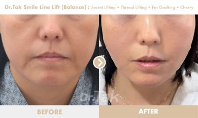 before-after photo mini-facelift