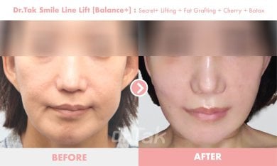 before-after photo mini-facelift