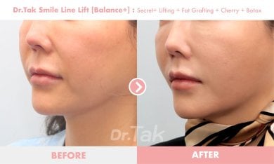 before-after photo mini-facelift