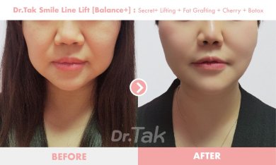 before-after photo mini-facelift